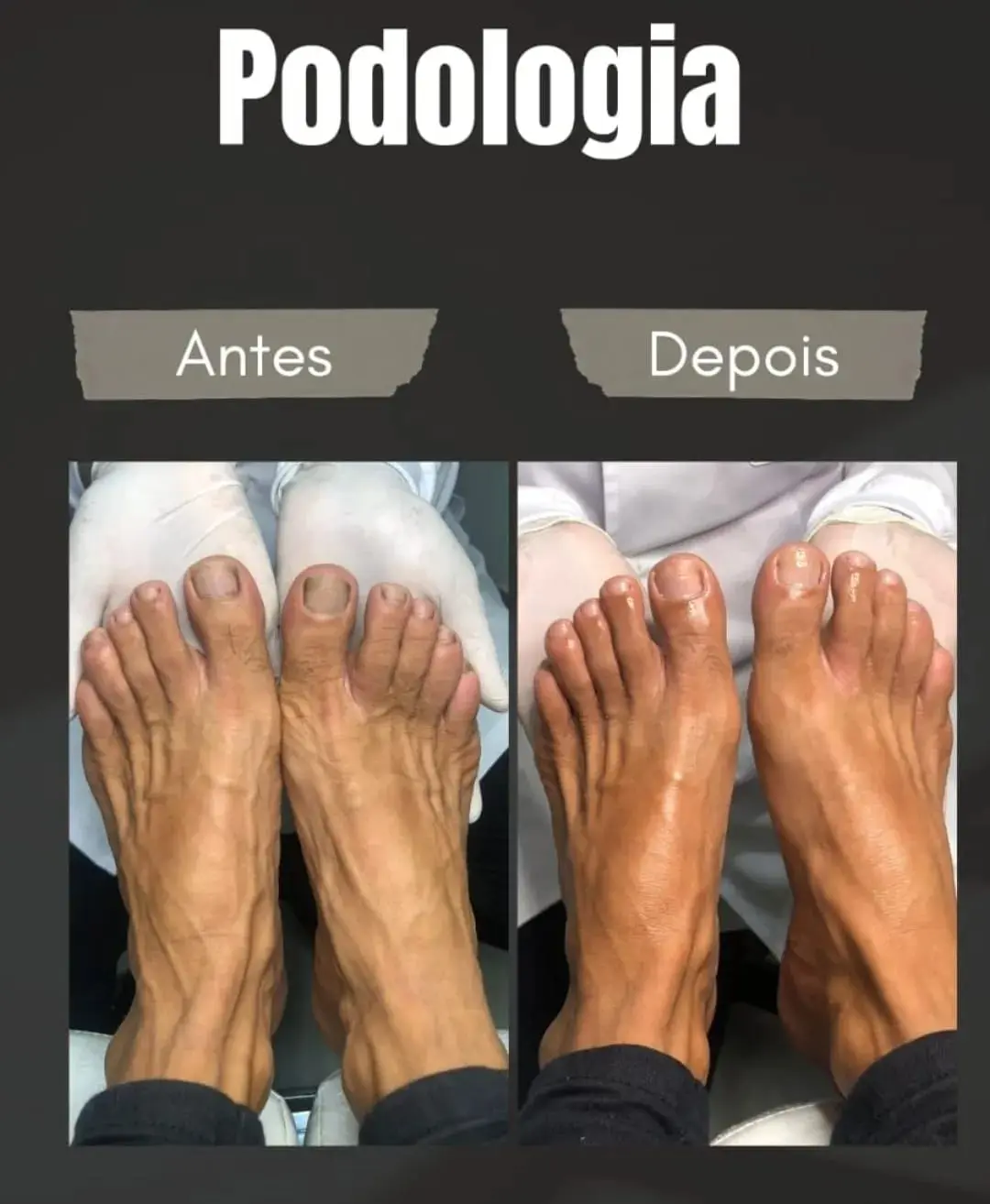 Resultado real de cuidados podológicos